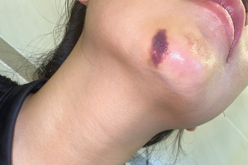 Signs of filler injection into blood vessels
