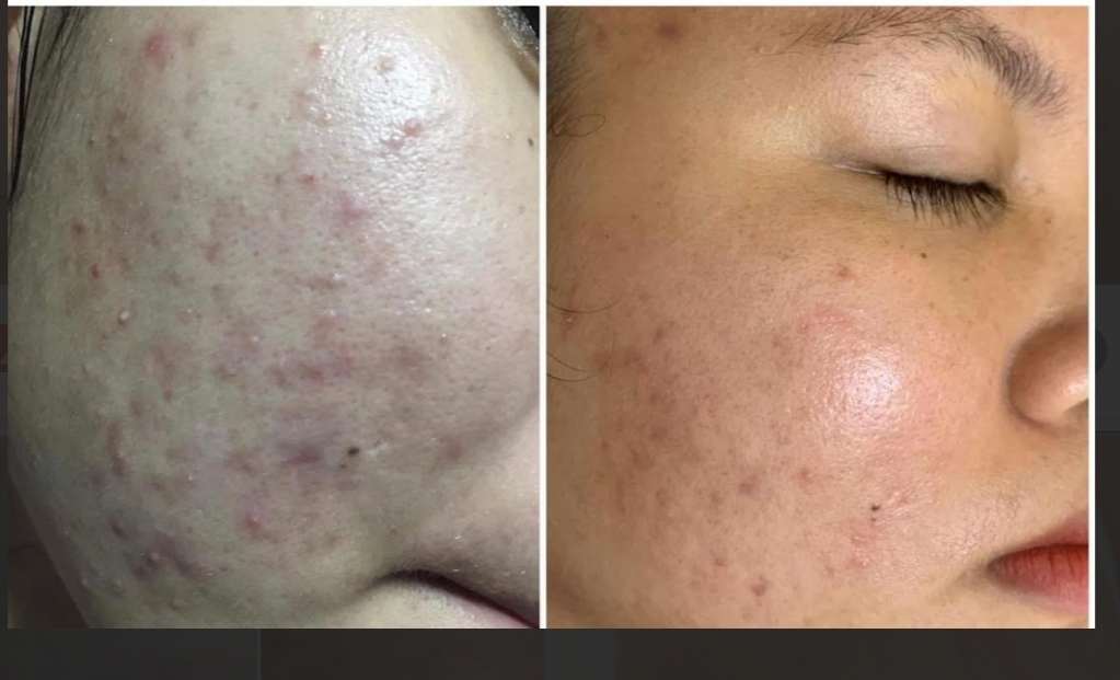 Đây là trước và sau khi kết thúc liệu trình