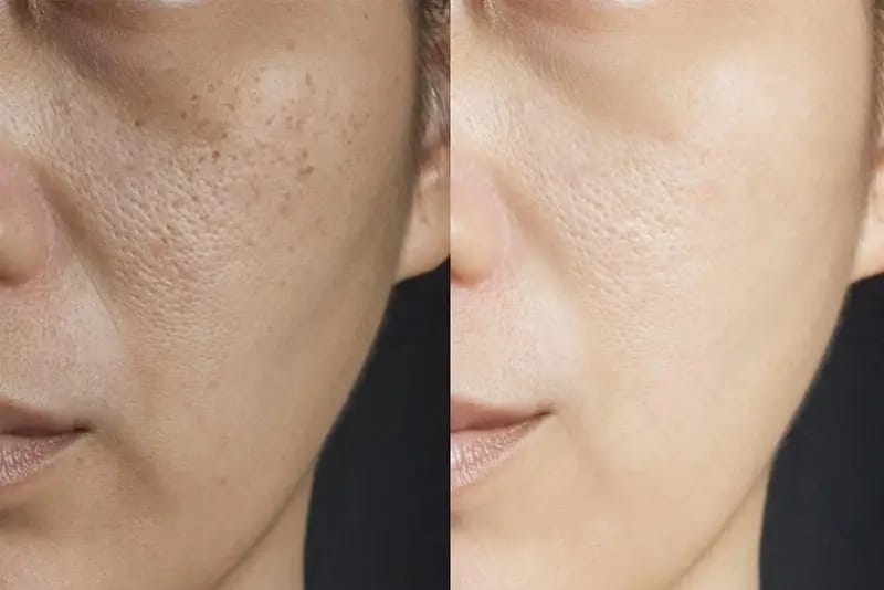 Đôi nét về Peel da và tiêm Meso