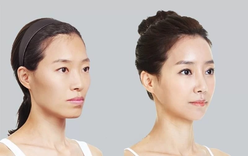 Giá tiêm hạ gò má tham khảo trên thị trường