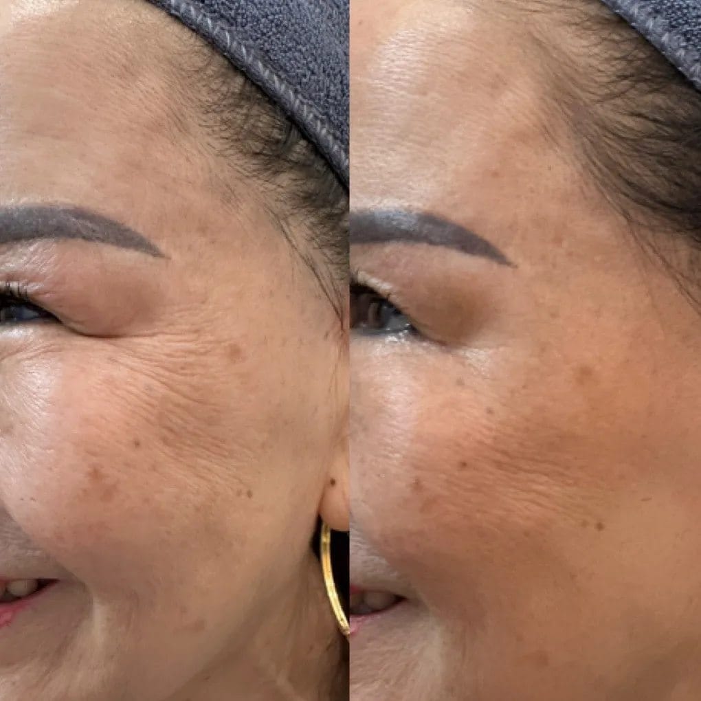 HBIO Clinic - Địa chỉ chăm sóc da bị nám uy tín, giá TỐT