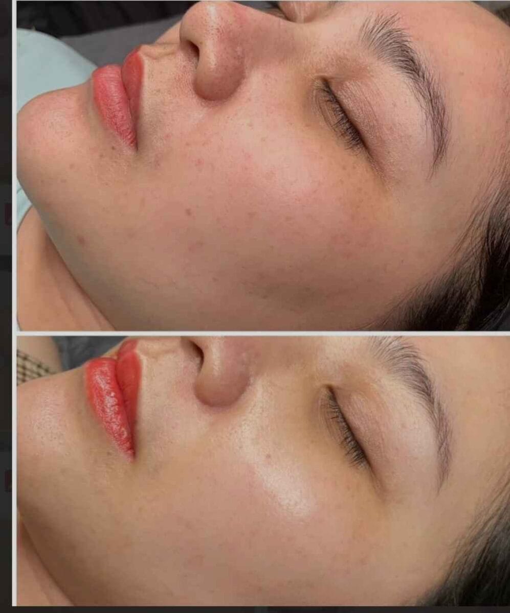 Hình ảnh thực tế trước và sau khi điều trị mụn bằng ánh sáng xanh