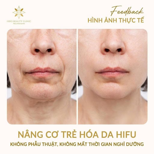 Hình ảnh thực tế trước và sau khi HIFU
