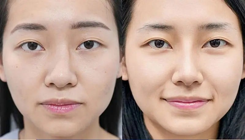 Hình ảnh trước và sau khi chỉnh lệch vách ngăn mũi