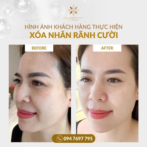 Hình ảnh trước và sau khi tiêm rãnh cười