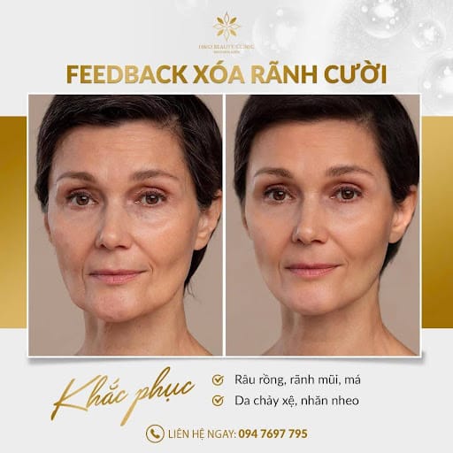 Hình ảnh trước và sau khi tiêm rãnh cười