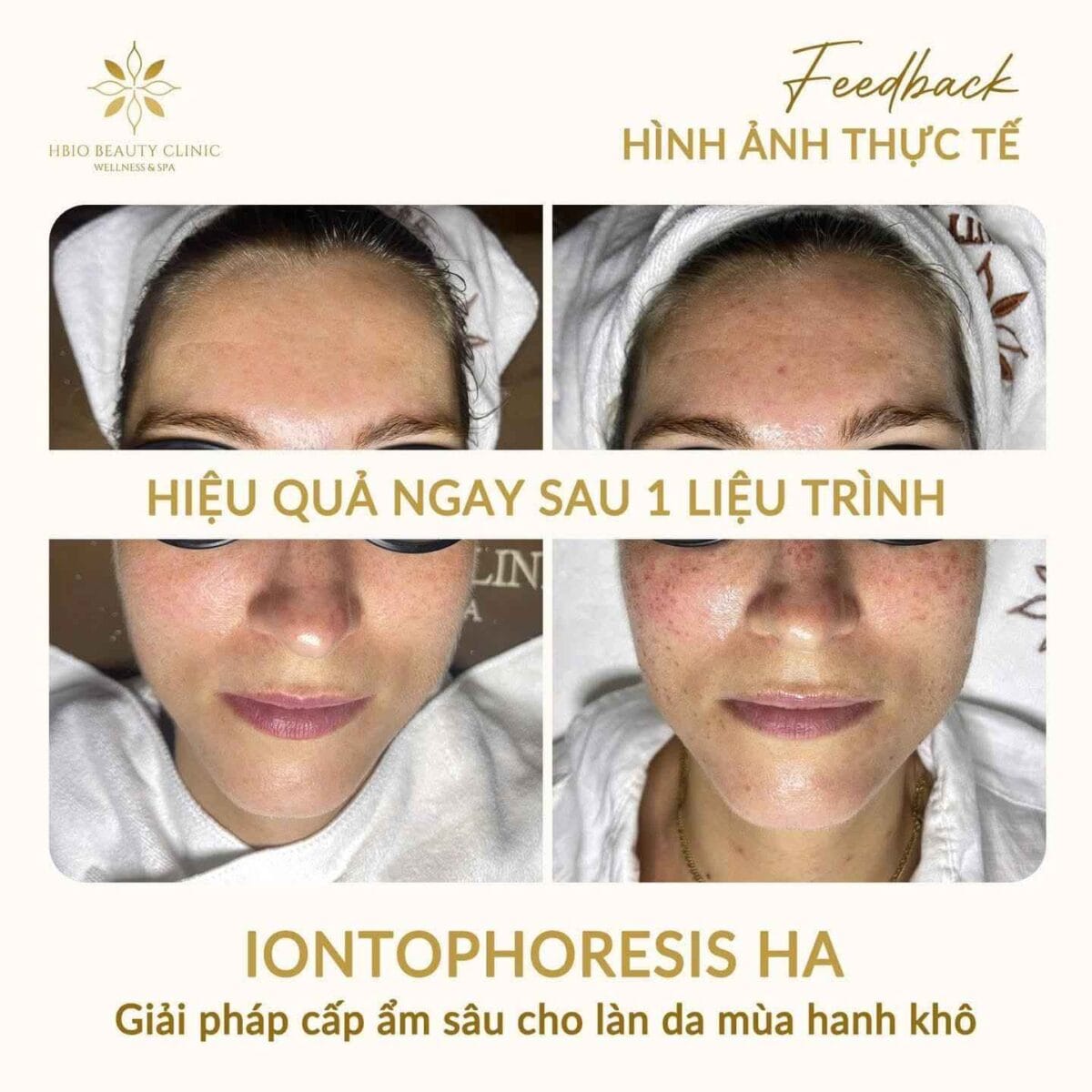 Hình ảnh trước và sau liệu trình chăm sóc da chuyên sâu HBIO