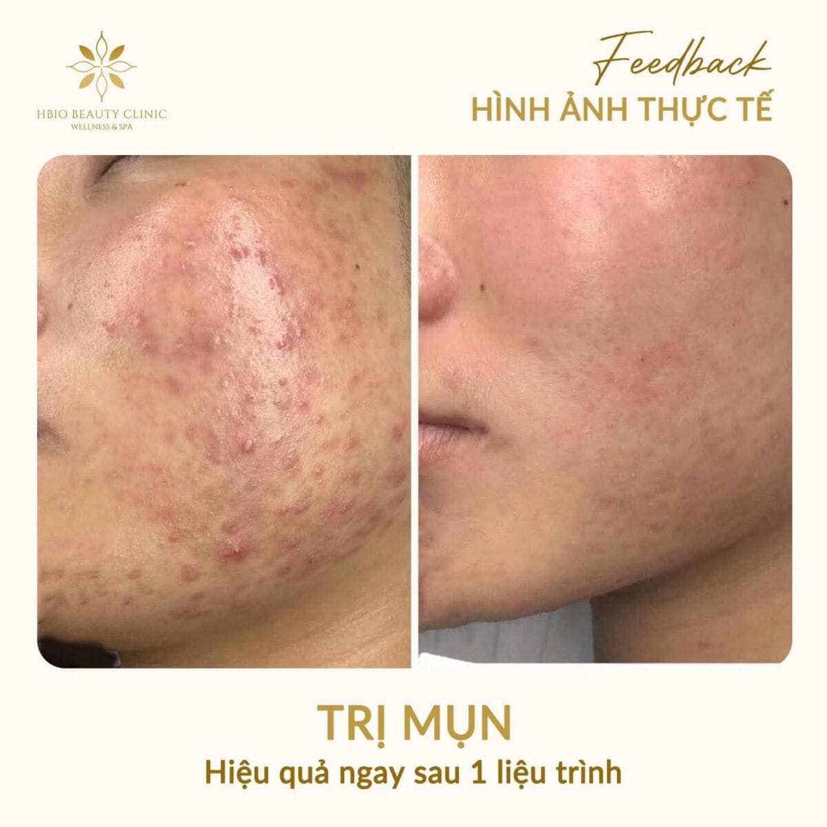 Hình ảnh trước và sau khi điều trị mụn