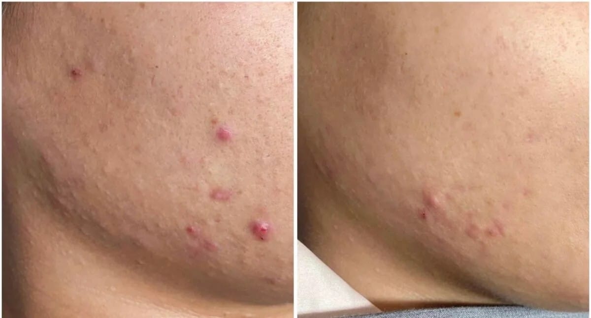 Hình ảnh trước và sau liệu trình điều trị mụn