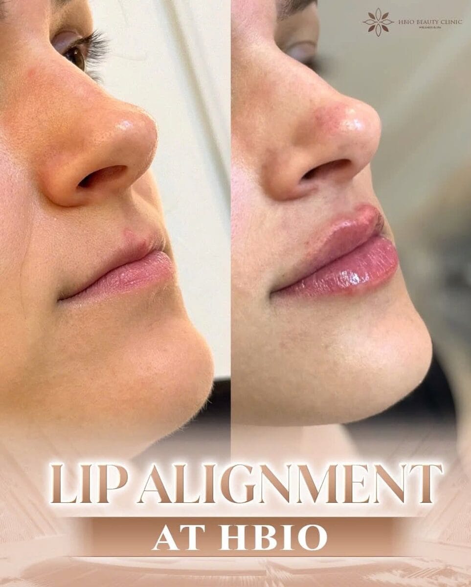 Hình ảnh trước và sau tiêm filler môi