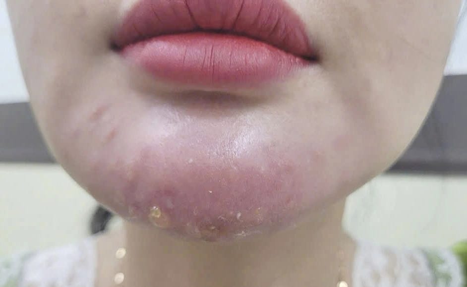 When should I NOT get another filler injection?