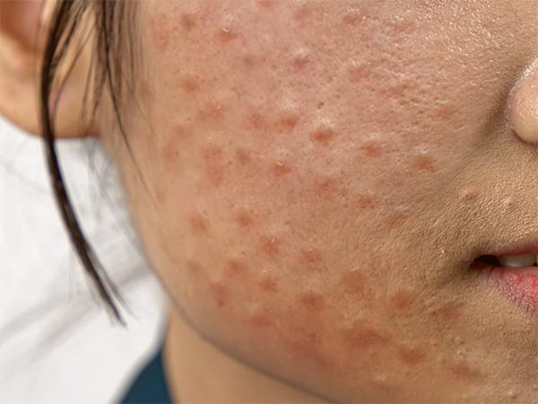 Kỹ thuật tiêm Meso không chuẩn