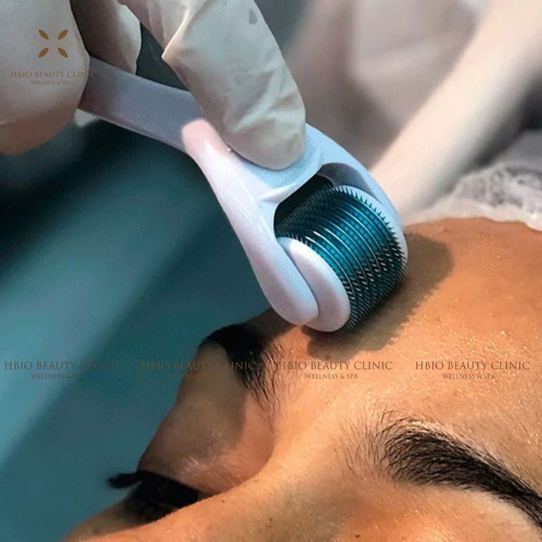 Lăn kim trị sẹo rỗ