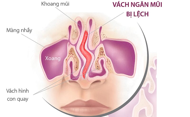 Lệch vách ngăn mũi