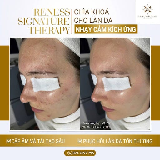 Liệu trình chăm sóc da nhạy cảm chuyên sâu tại HBIO Clinic