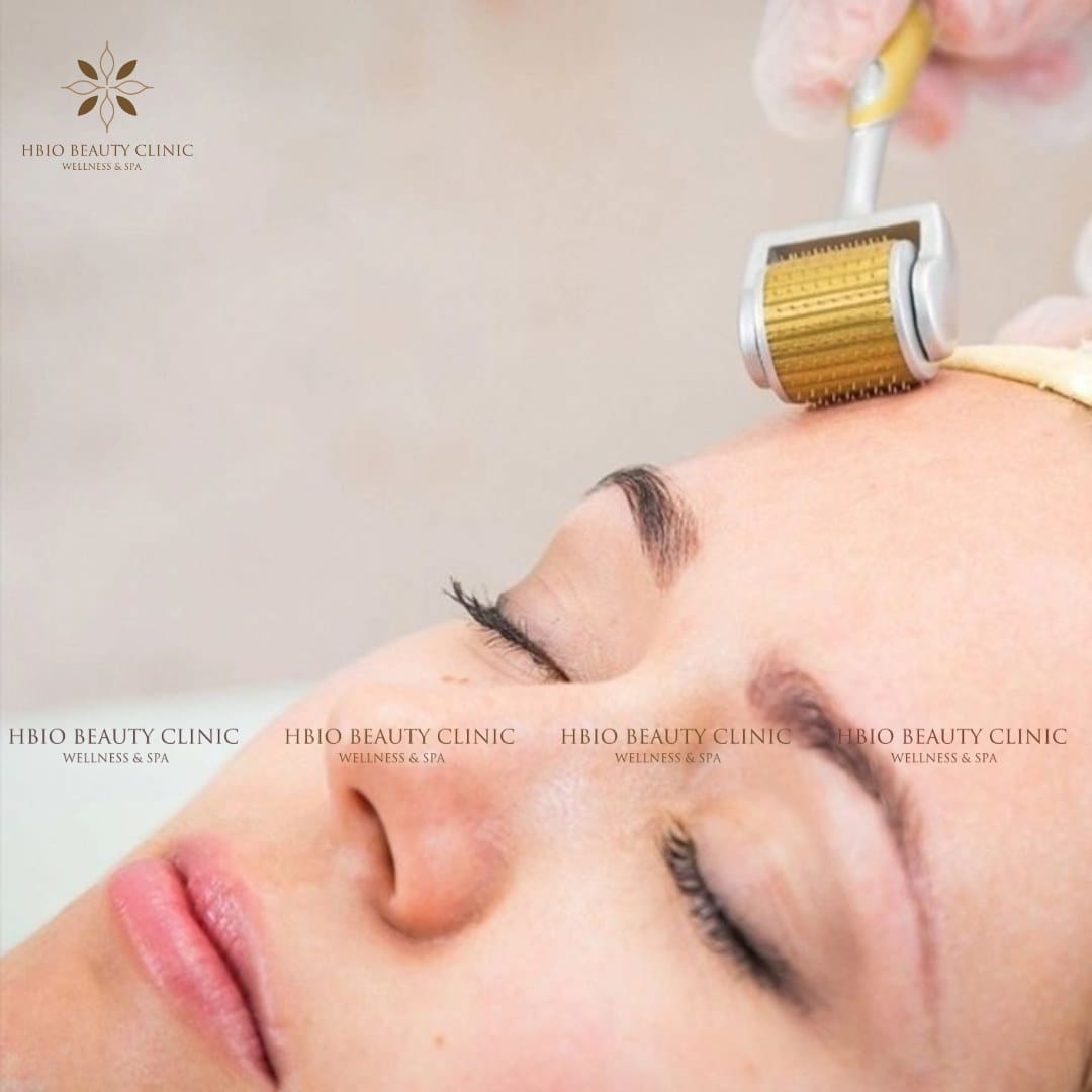 Liệu trình lăn kim trị sẹo rỗ là bao nhiêu