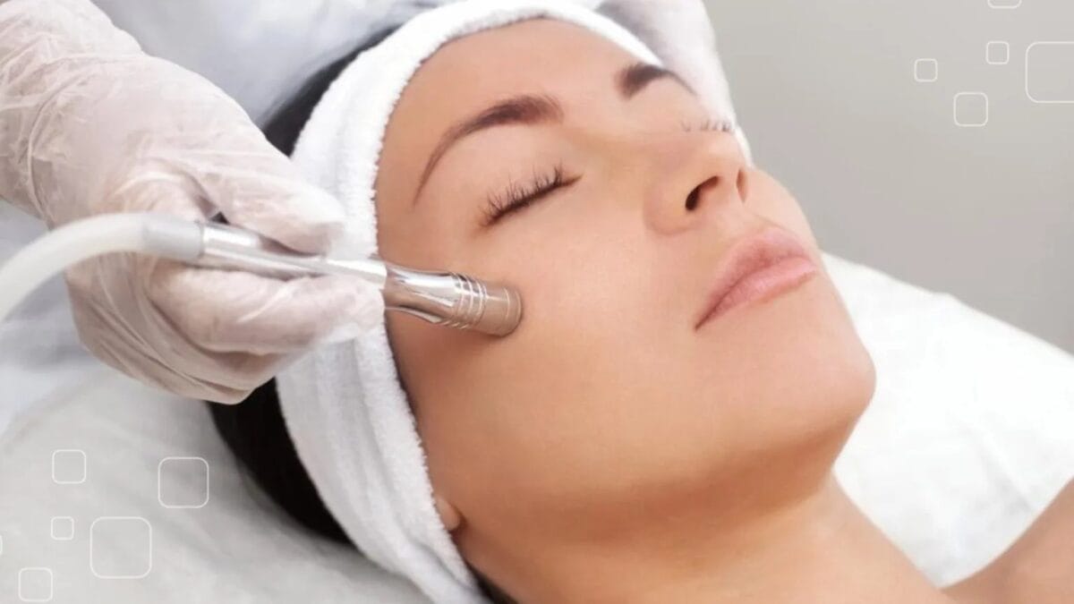 Mài da vi điểm giúp giảm sẹo lỗ, da trắng mịn