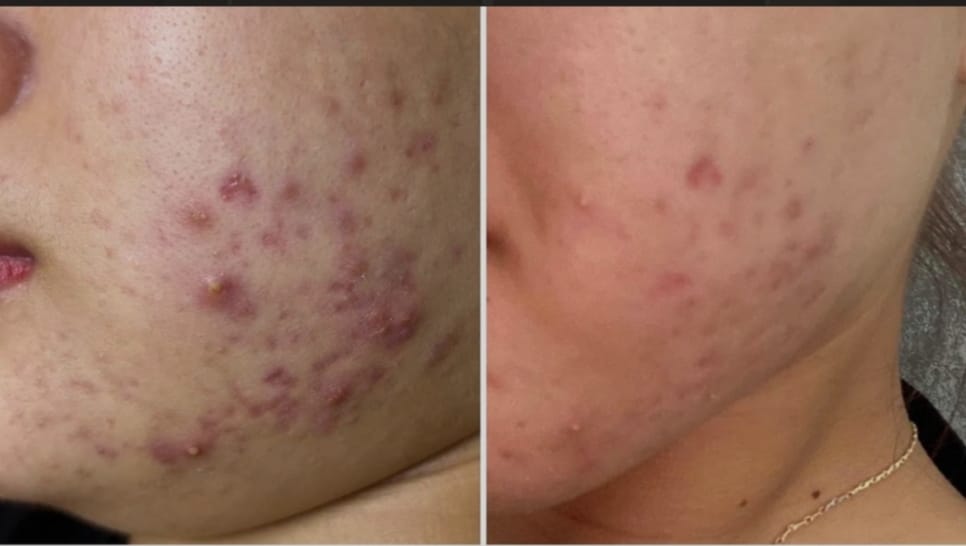 Mụn ẩn trồi lên khi sử dụng retinol