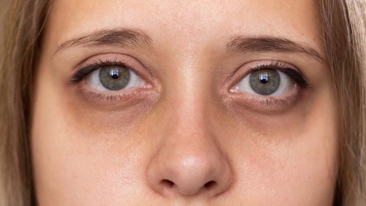 Causes of dark circles under the eyes
