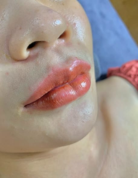 Những lưu ý khi tiêm môi trái tim