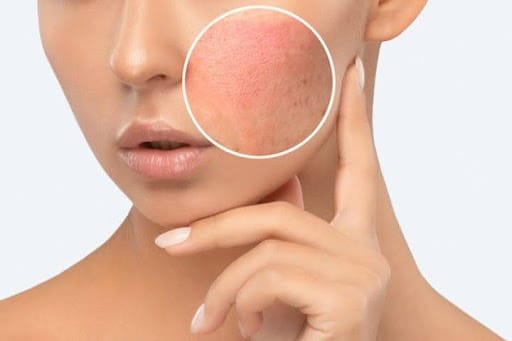 Những sai lầm thường gặp khi chăm sóc da nhạy cảm