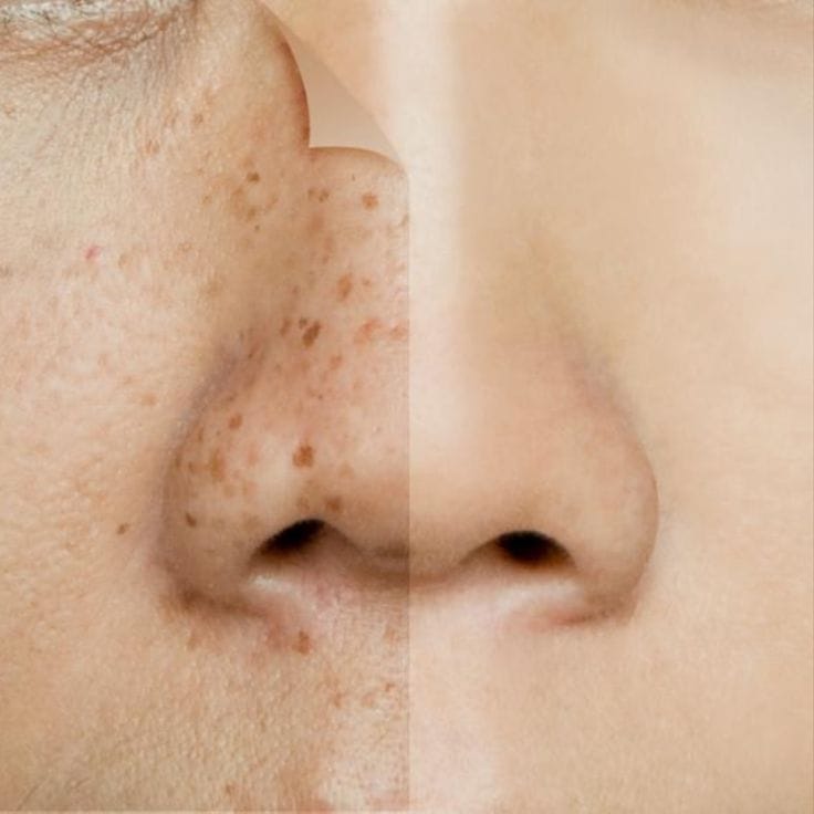 Niacinamide làm sáng da, cải thiện sắc tố