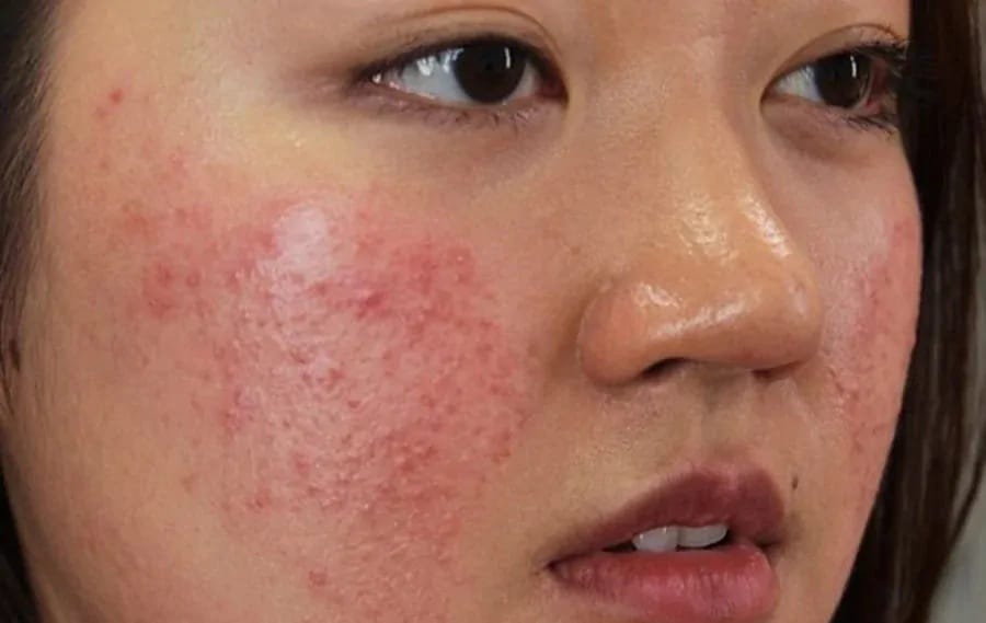 Quy trình chăm sóc da dầu mụn và nguyên nhân gây ra chúng