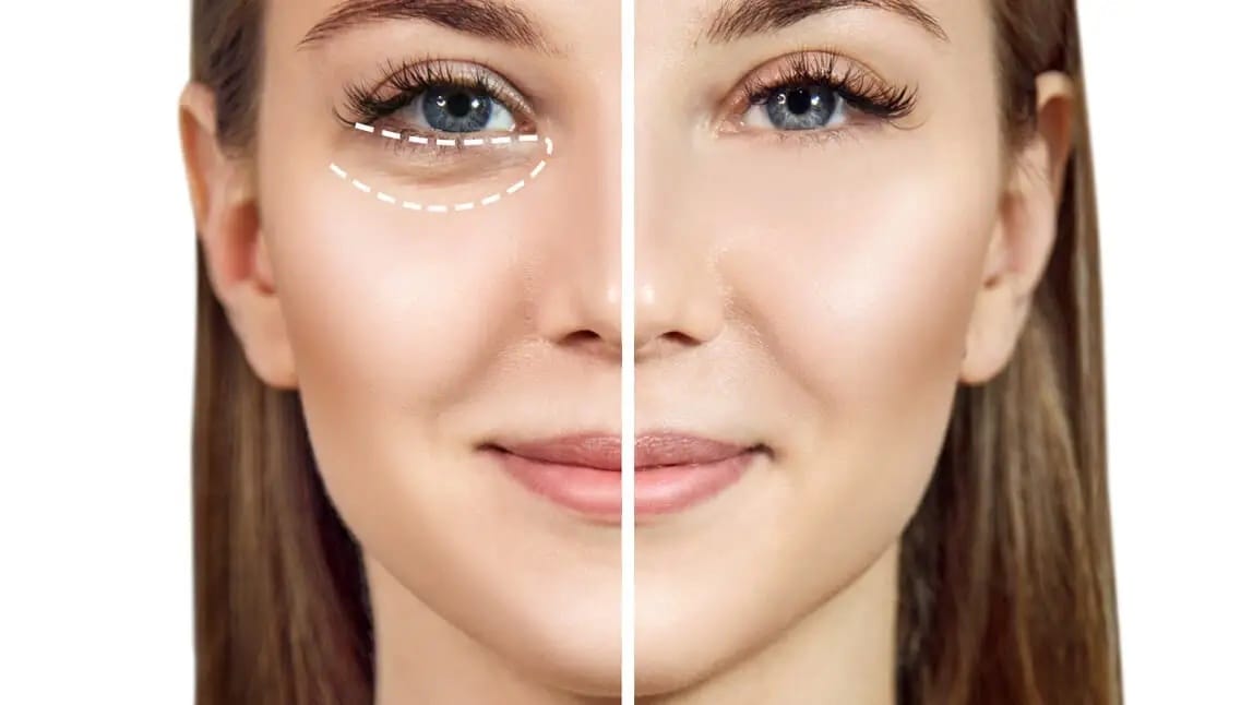 Procedure for dark circle removal injection at HBIO Clinic
