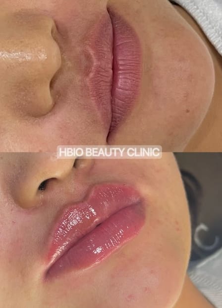Sử dụng filler chính hãng – yêu cầu kiểm tra trước khi tiêm