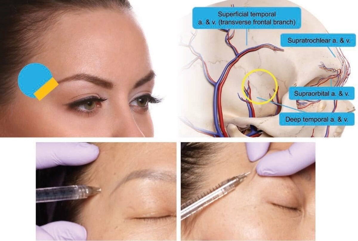 Tiêm filler làm đầy thái dương