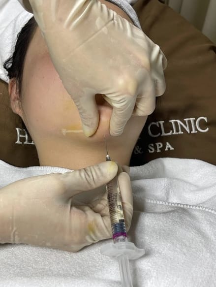 Is multiple filler injections harmful?