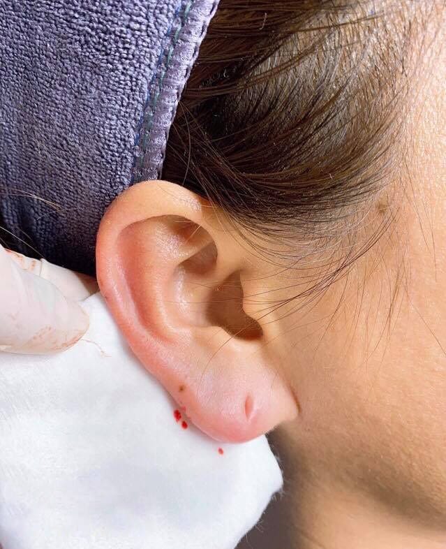 Tiêm filler tai được bao lâu?