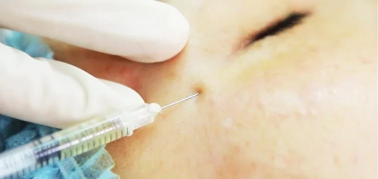 Tiêm filler – Làm đầy sẹo rỗ tức thì
