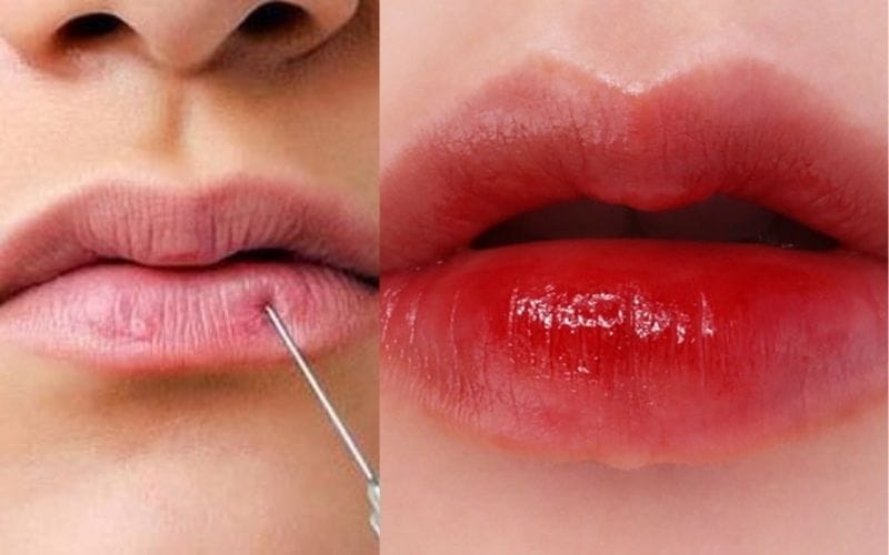 What is cherry lip injection?