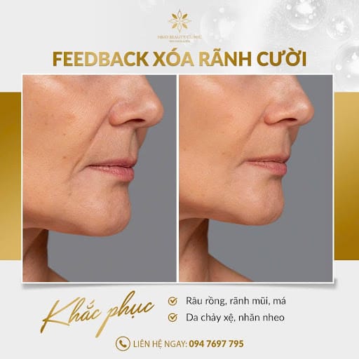 Tiêm rãnh cười bao nhiêu cc là đẹp