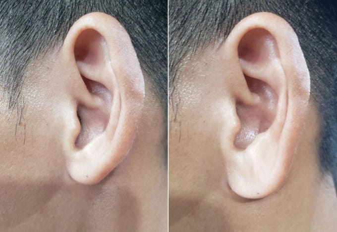 Tiêm tai tài lộc có tốt không?