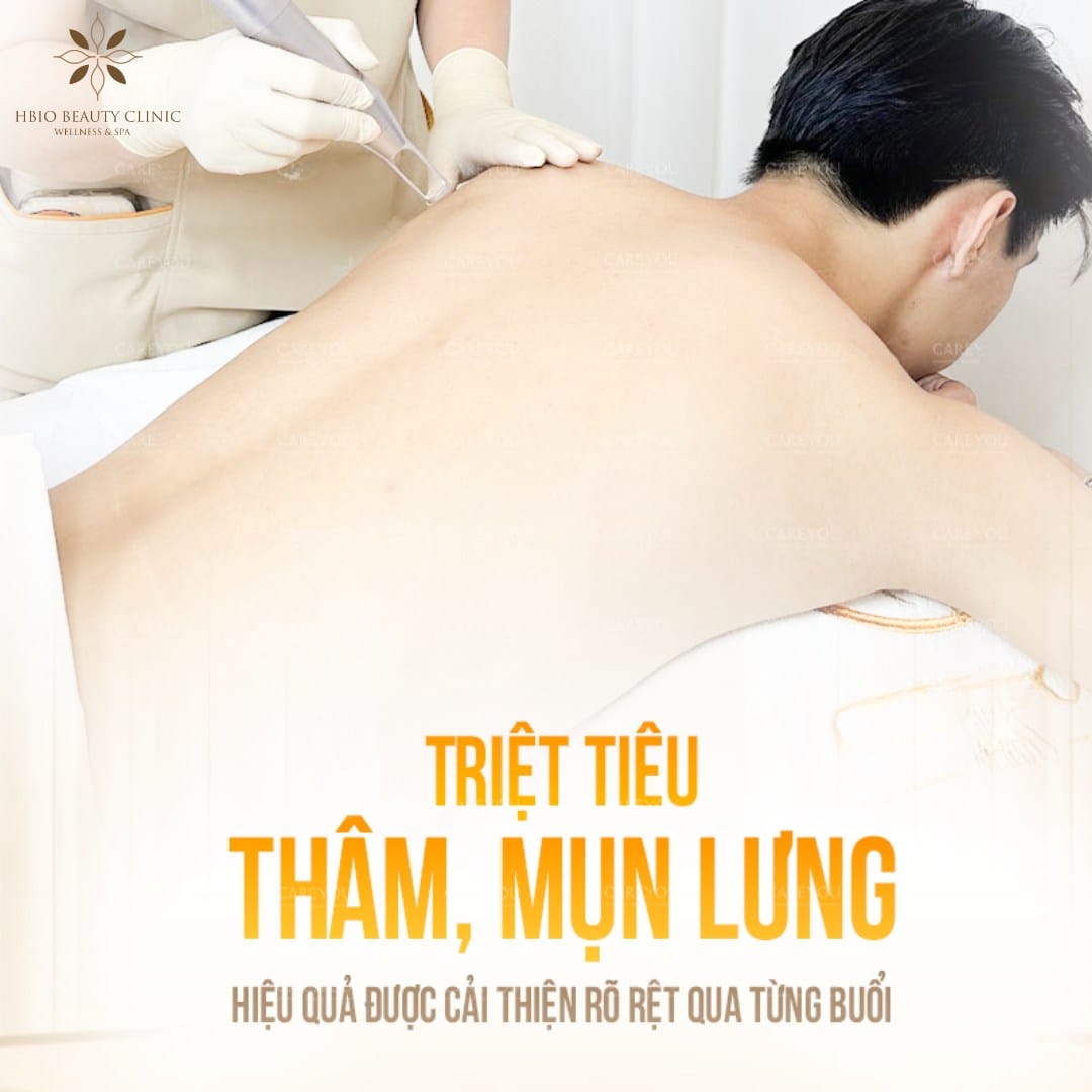 Trị thâm mụn lưng lâu năm bằng phương pháp laser