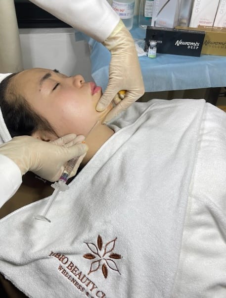Advantages of filler injection to treat acne scars