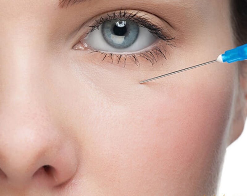Outstanding advantages of dark circle injection