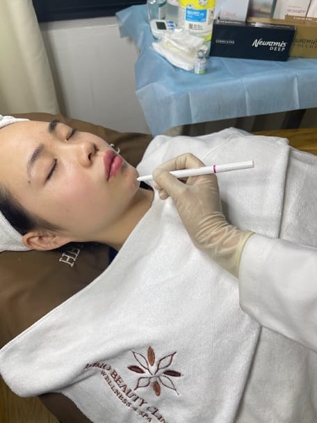 Advantages and disadvantages of filler injections to treat acne scars