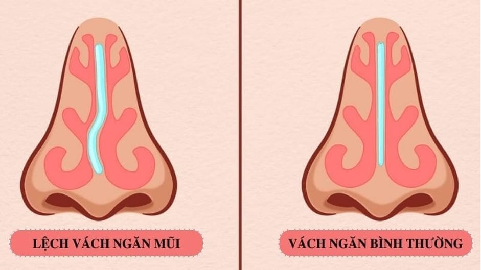 Vách ngăn mũi bị lệch và vách ngăn bình thường