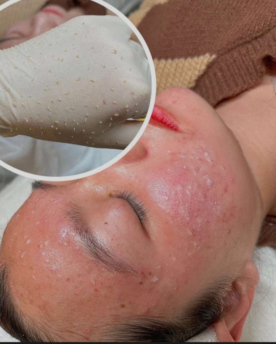 Vấn đề da phổ biến ở tuổi dậy thì