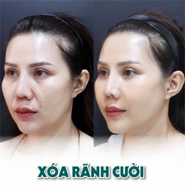 Xóa rãnh cười được thực hiện bởi Hbio Clinic