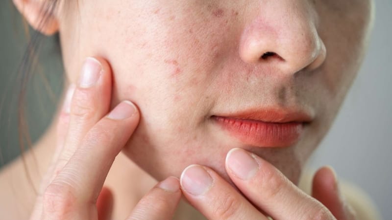 Chăm sóc da bị kích ứng đúng cách