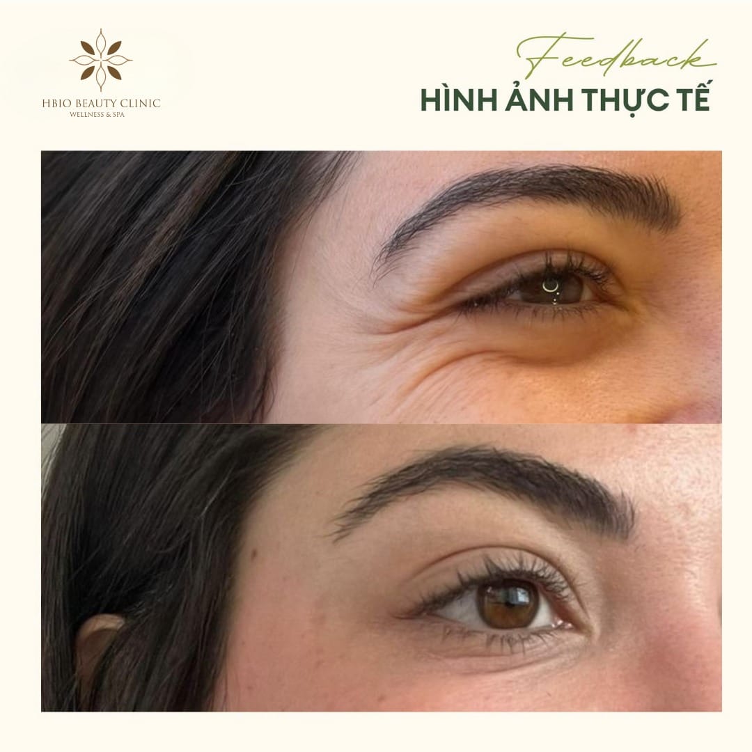 Juvederm filler reduces eye wrinkles fast