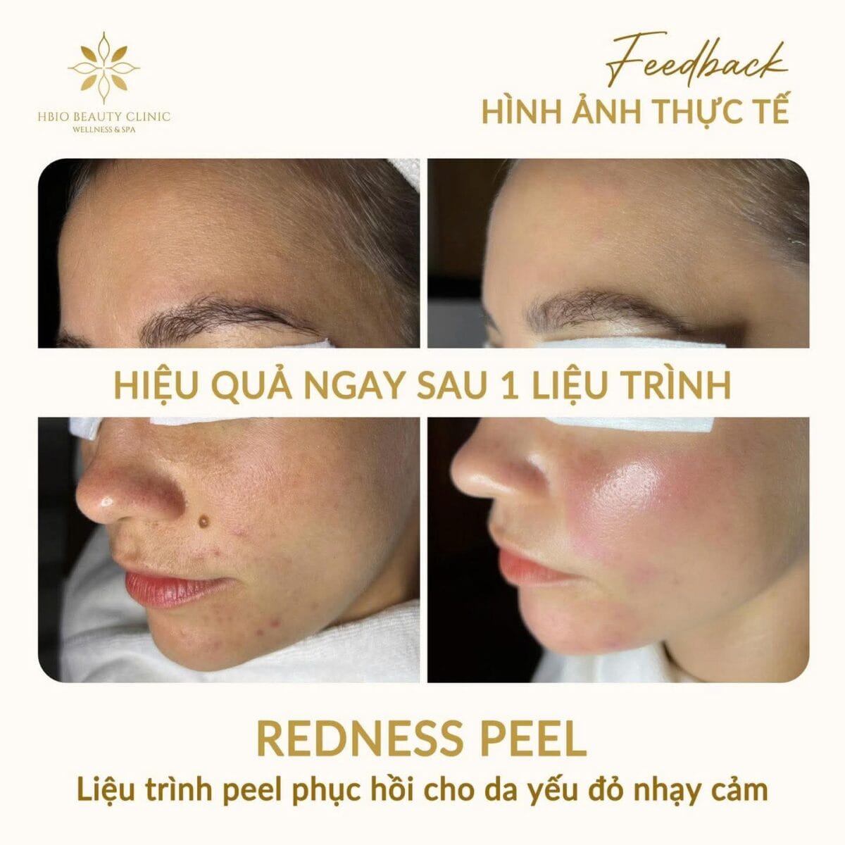 Hình ảnh trước và sau liệu trình chăm sóc da Redness Peel