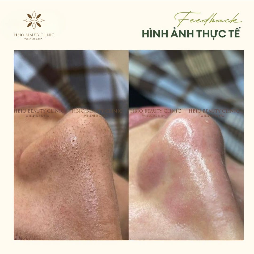 Hút bã nhờn và làm sạch mụn cám