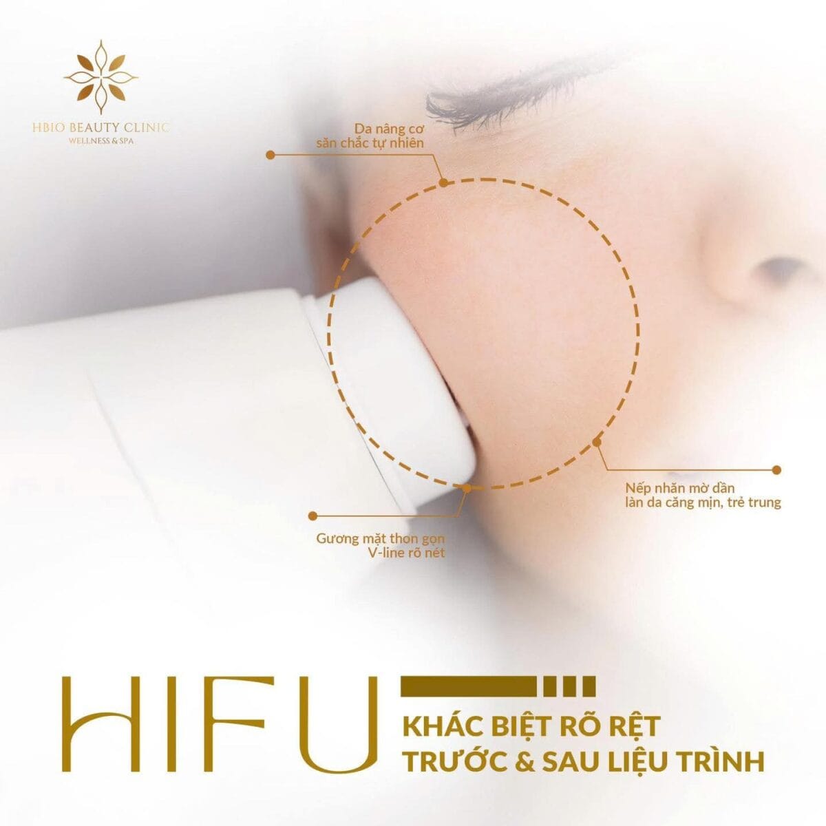 Liệu trình chăm sóc da mặt với công nghệ HIFU