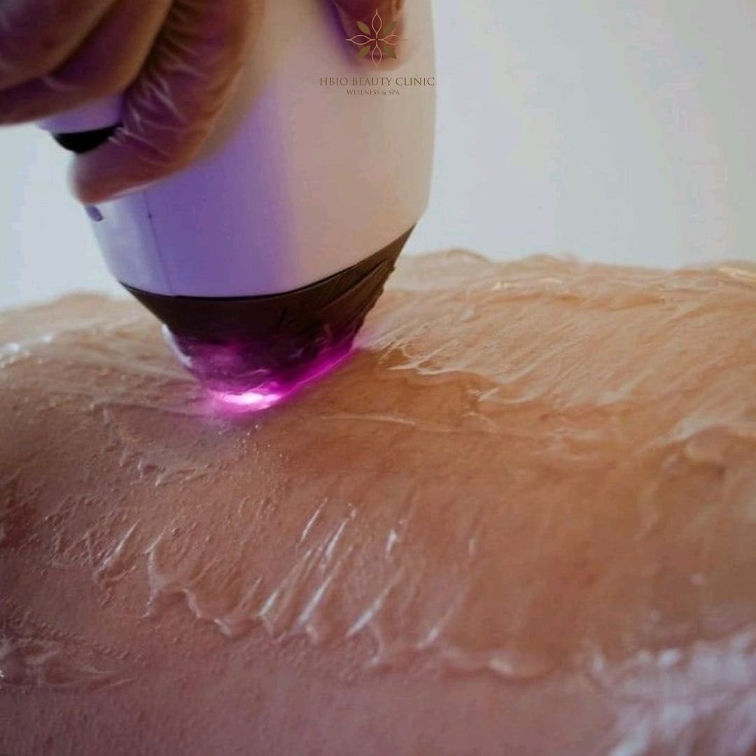 Triệt lông vĩnh viễn bao lâu thì cần triệt lại?