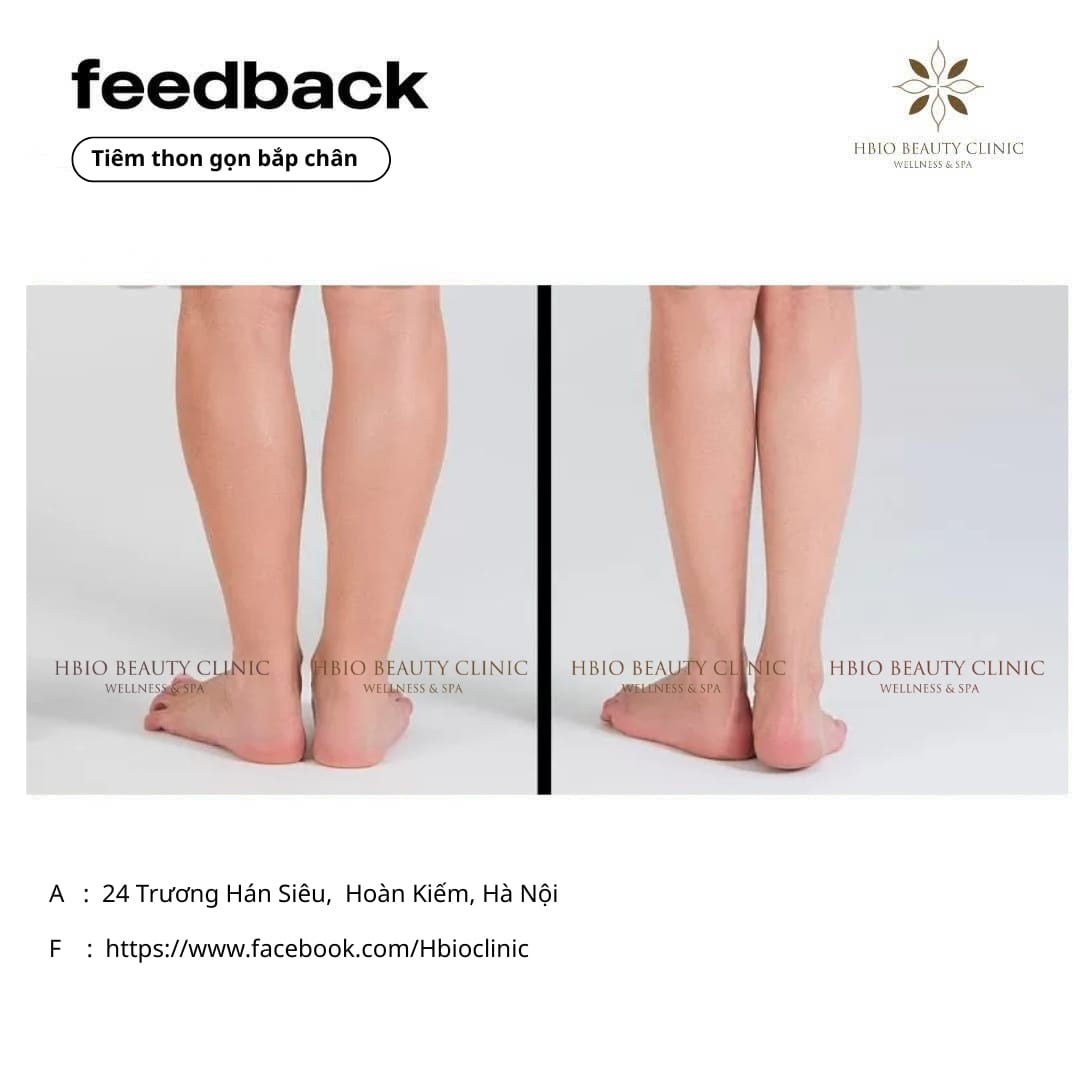 Quy trình tiêm thon gọn bắp chân tại HBIO Clinic